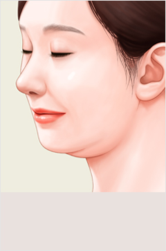 얼굴지방흡입 이미지