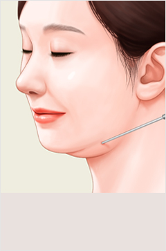얼굴지방흡입 이미지