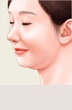 얼굴지방흡입 이미지
