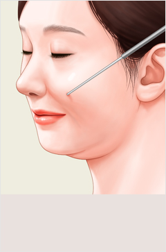 얼굴지방흡입 이미지